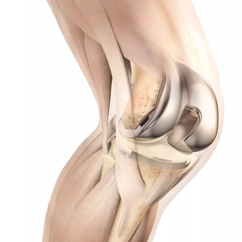 What Is a Knee Replacement?