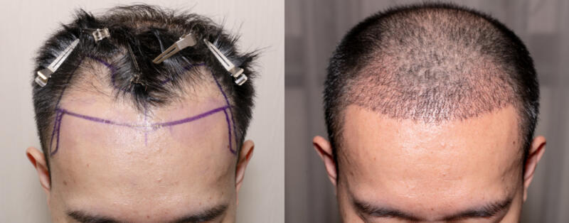 After a Hair Transplant: What to Expect - KiwiMedi Blog